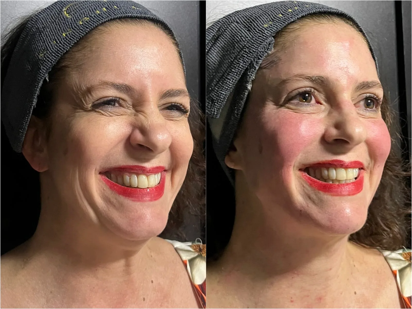 Perda de contorno facial — imagem clínica 2