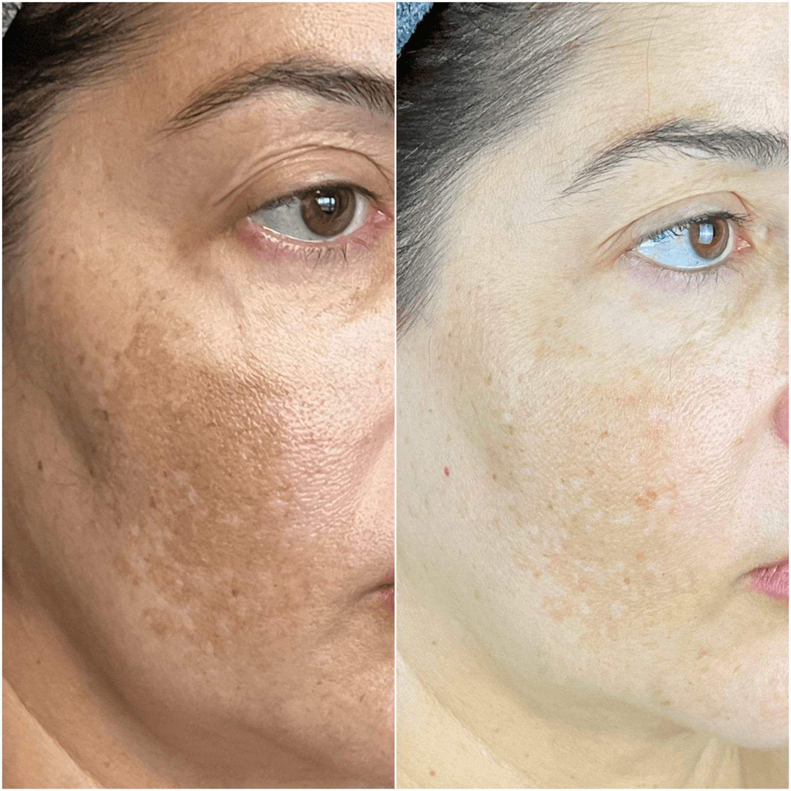 Manchas e melasma pós-gestação — resultado clínico 3