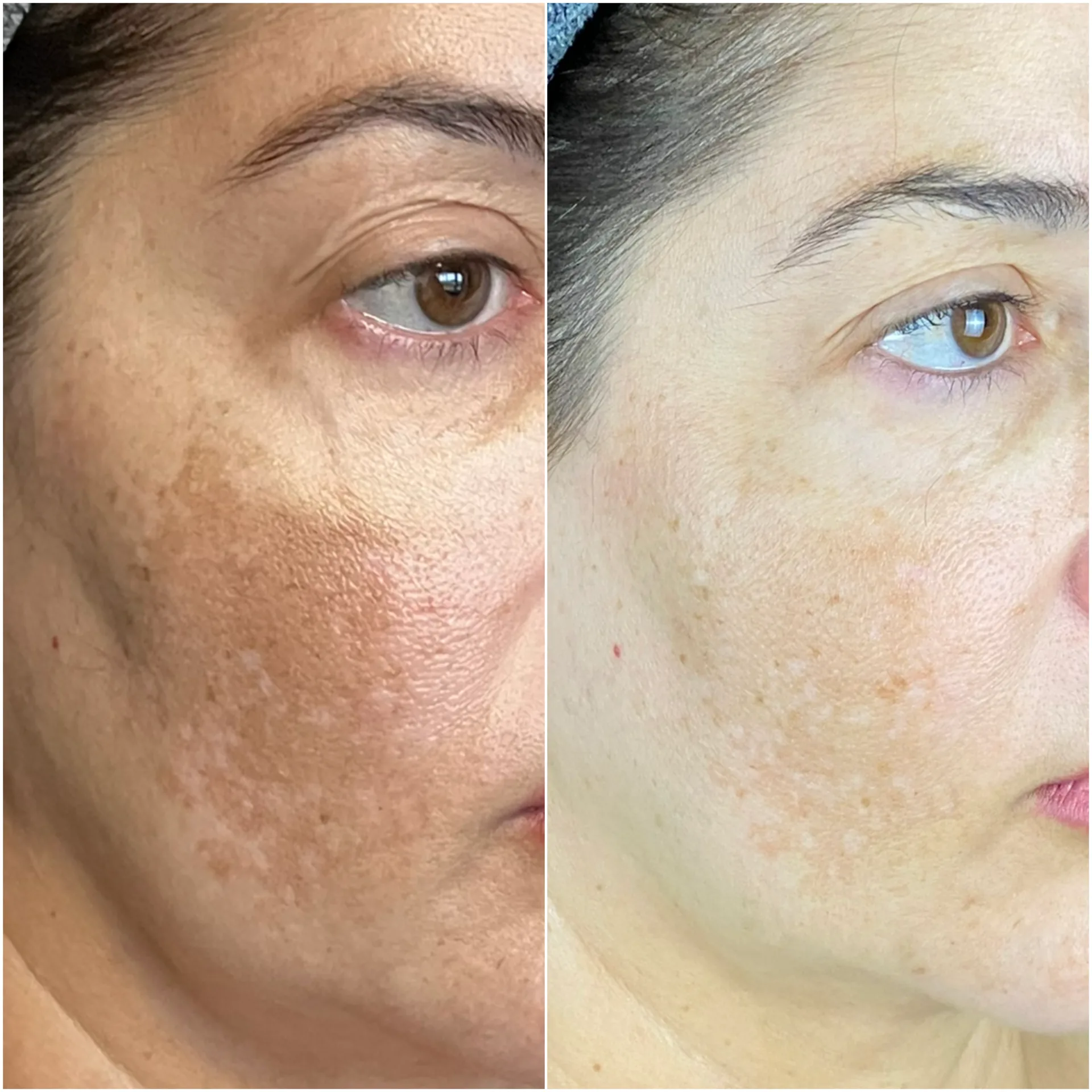Manchas e melasma pós-gestação — resultado clínico 3
