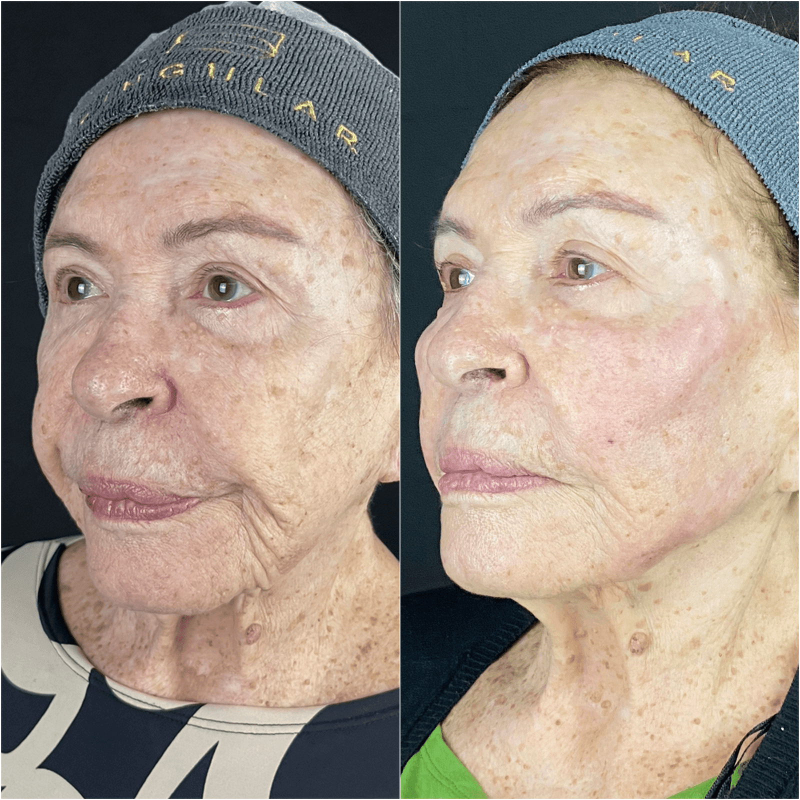Derretimento facial — imagem clínica 3