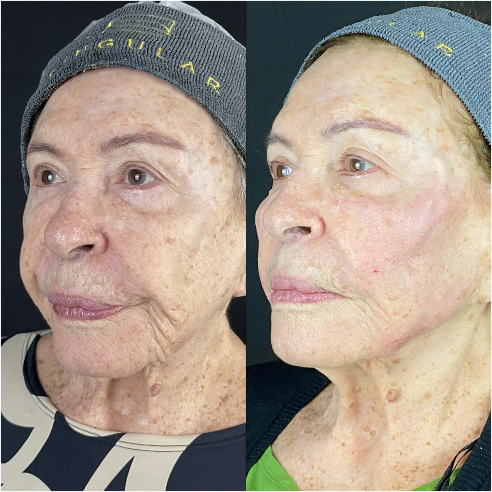 Derretimento facial — imagem clínica 3