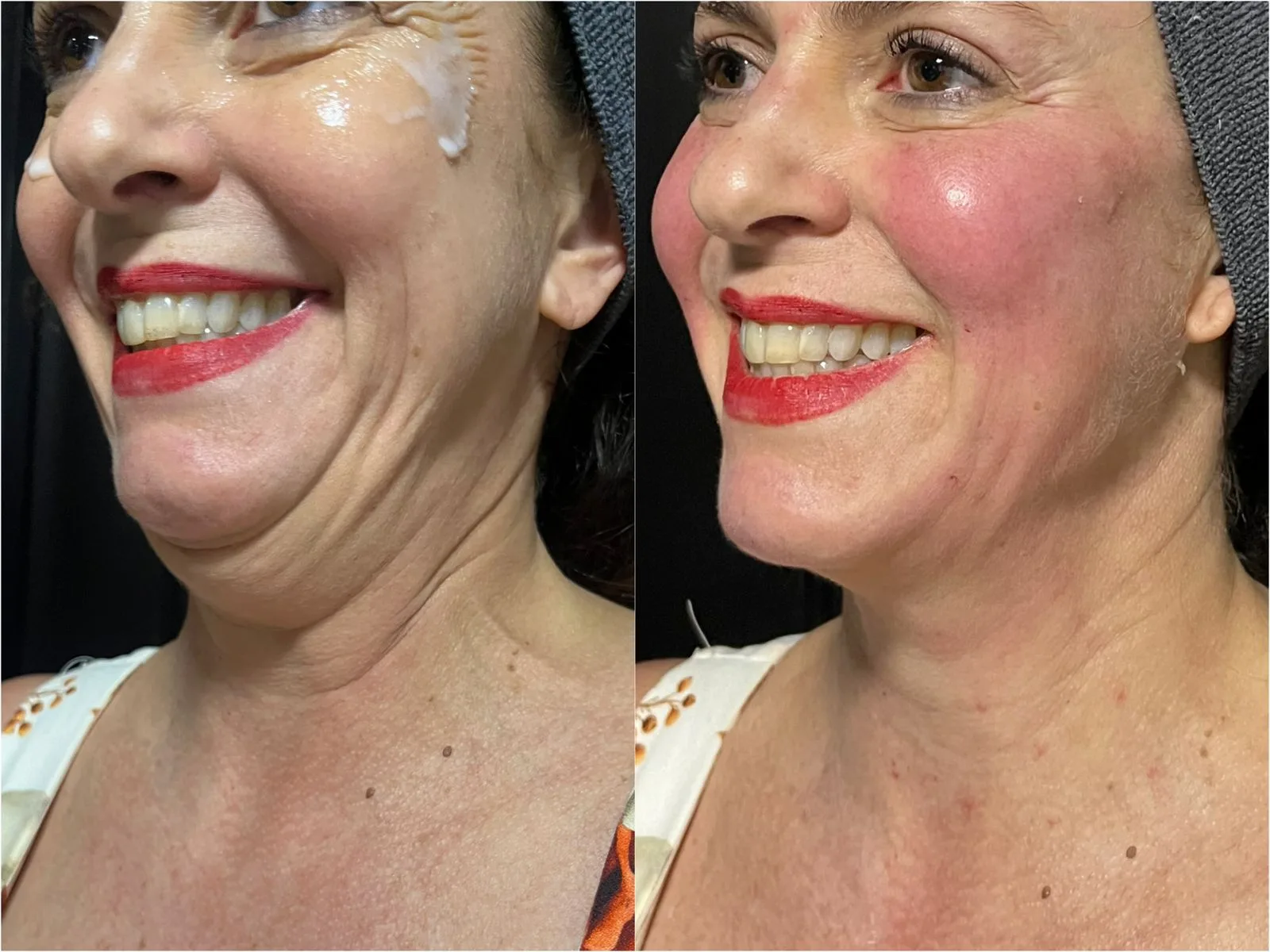 Perda de contorno facial — imagem clínica 1