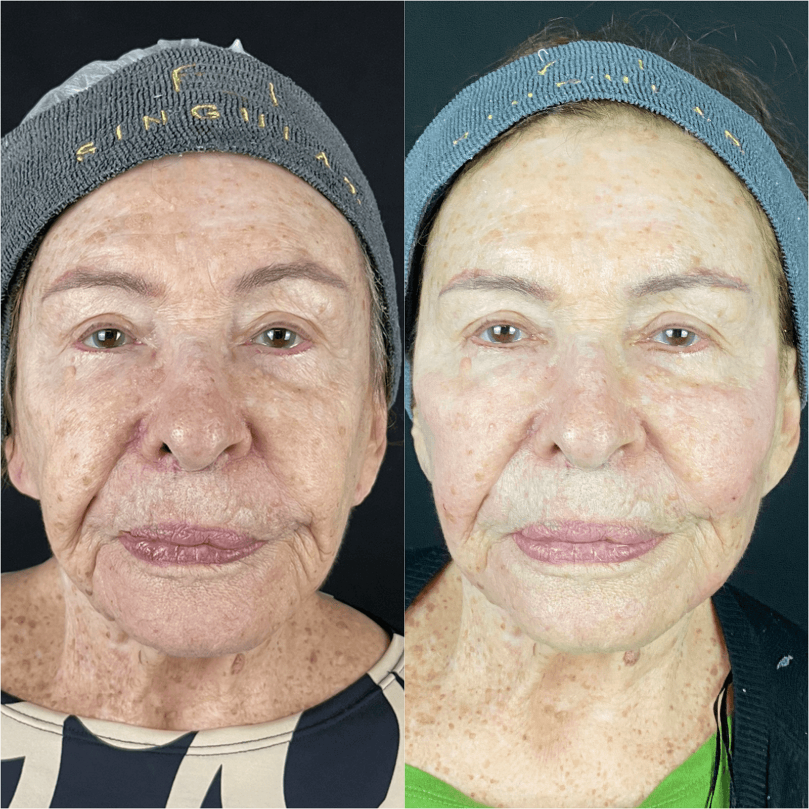 Derretimento facial — imagem clínica 2