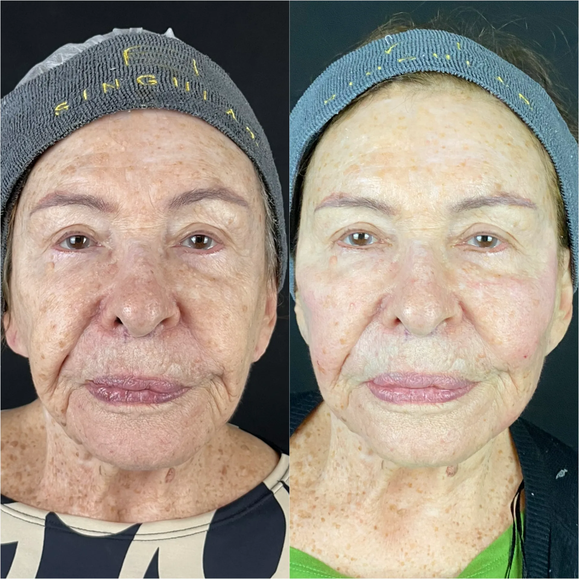 Derretimento facial — imagem clínica 2