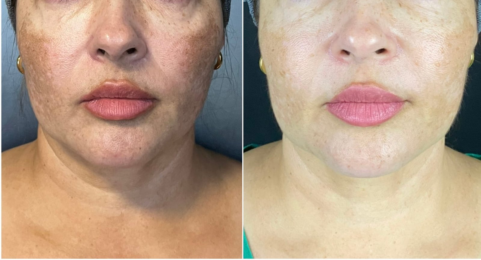 Manchas e melasma pós-gestação — resultado clínico 2