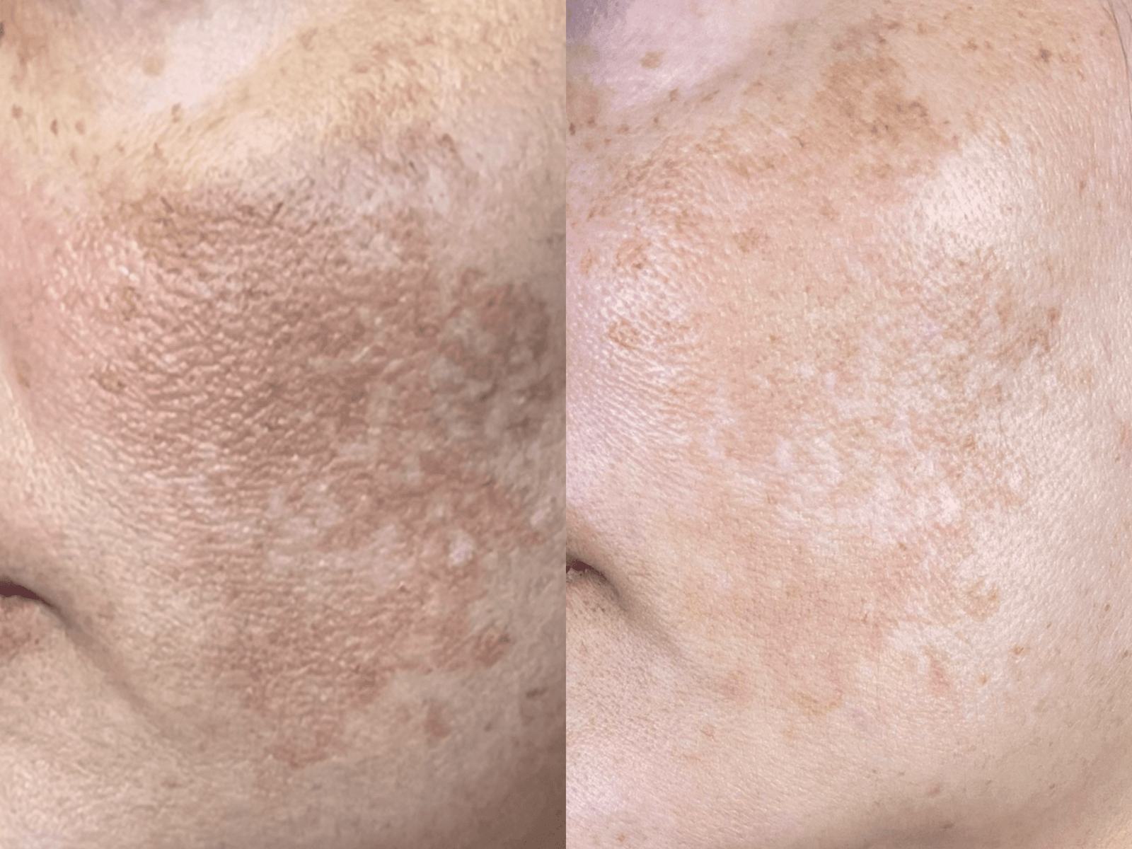 Manchas e melasma pós-gestação — resultado clínico 1