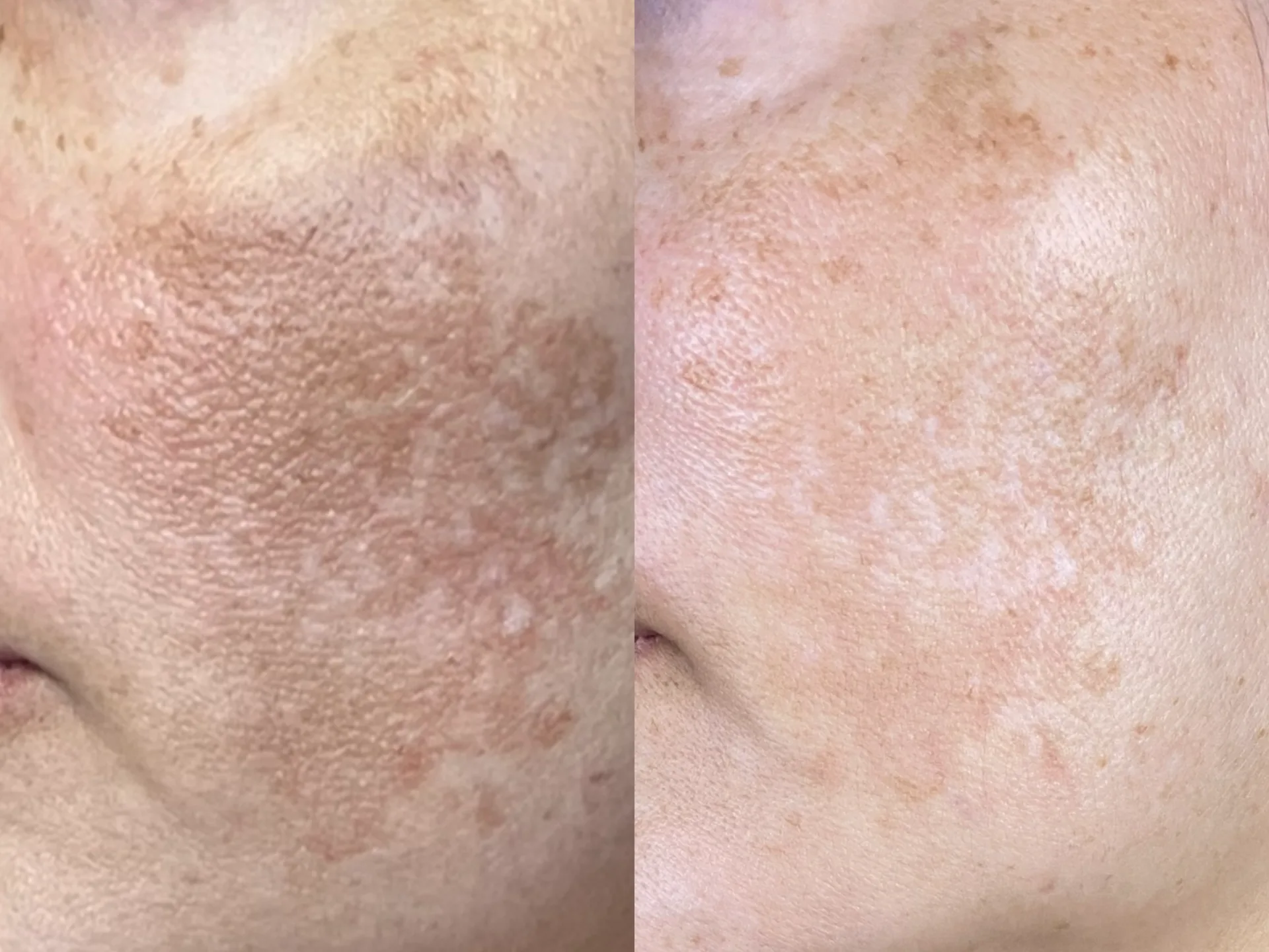 Manchas e melasma pós-gestação — resultado clínico 1