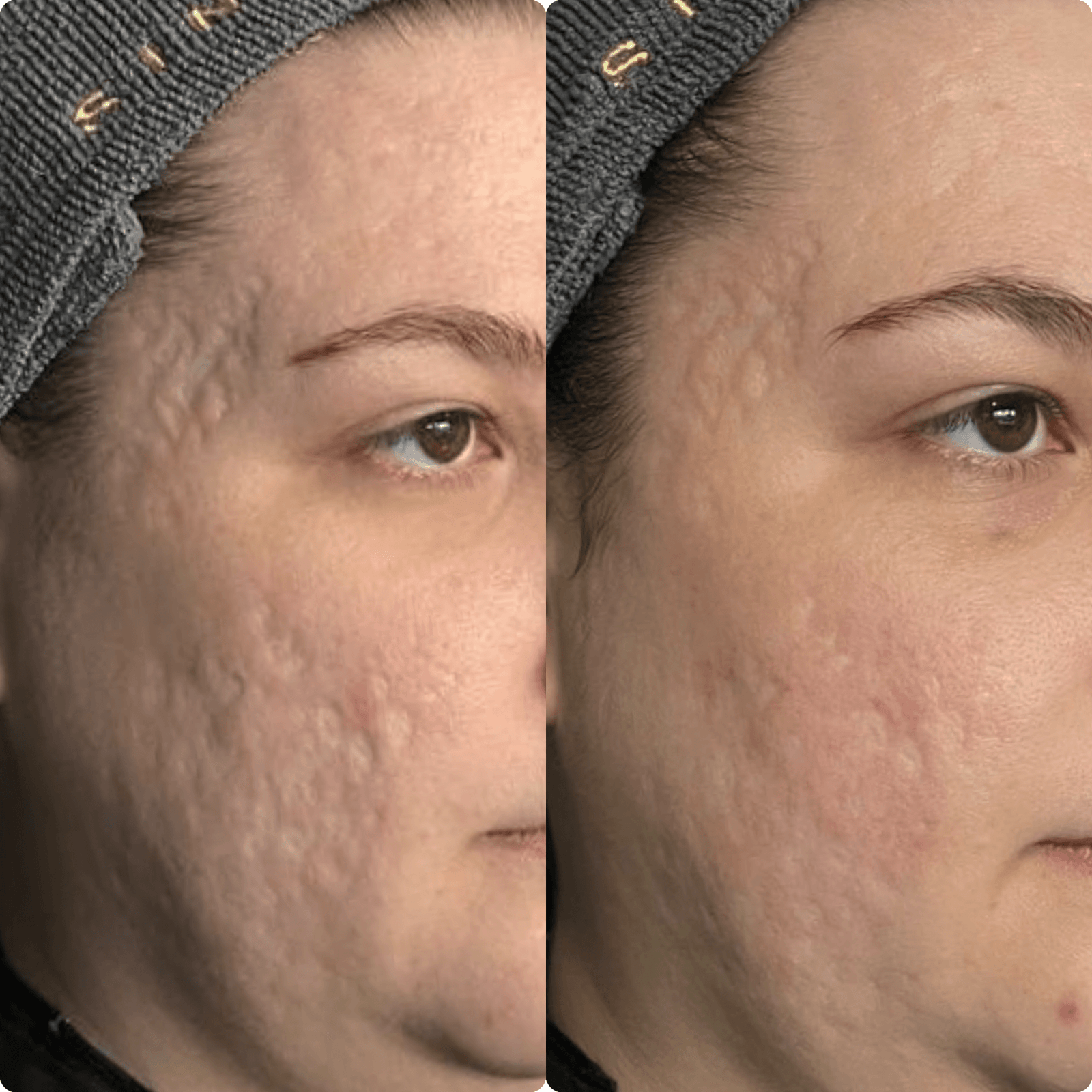 Cicatrizes de acne — resultado clínico 1