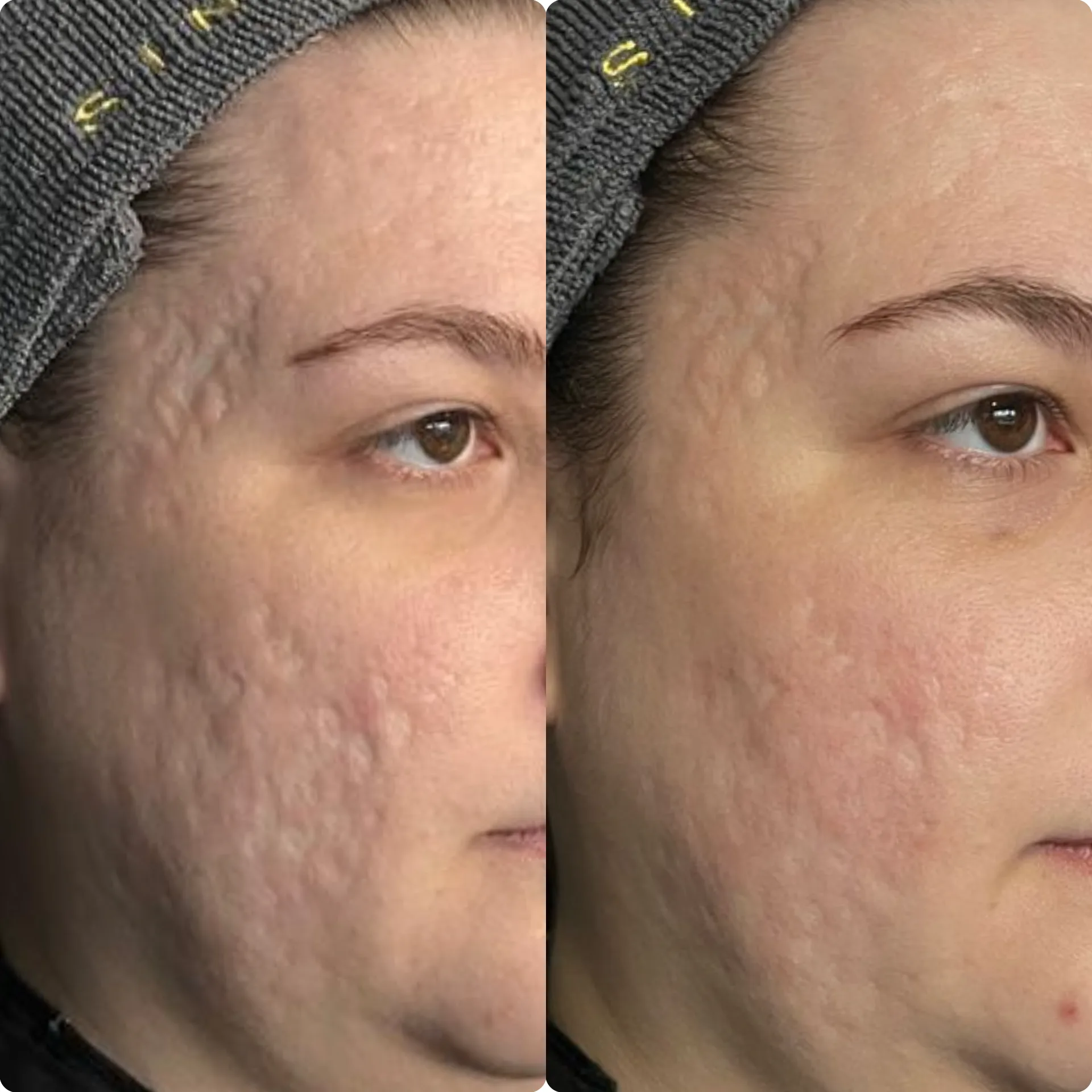 Cicatrizes de acne — resultado clínico 1