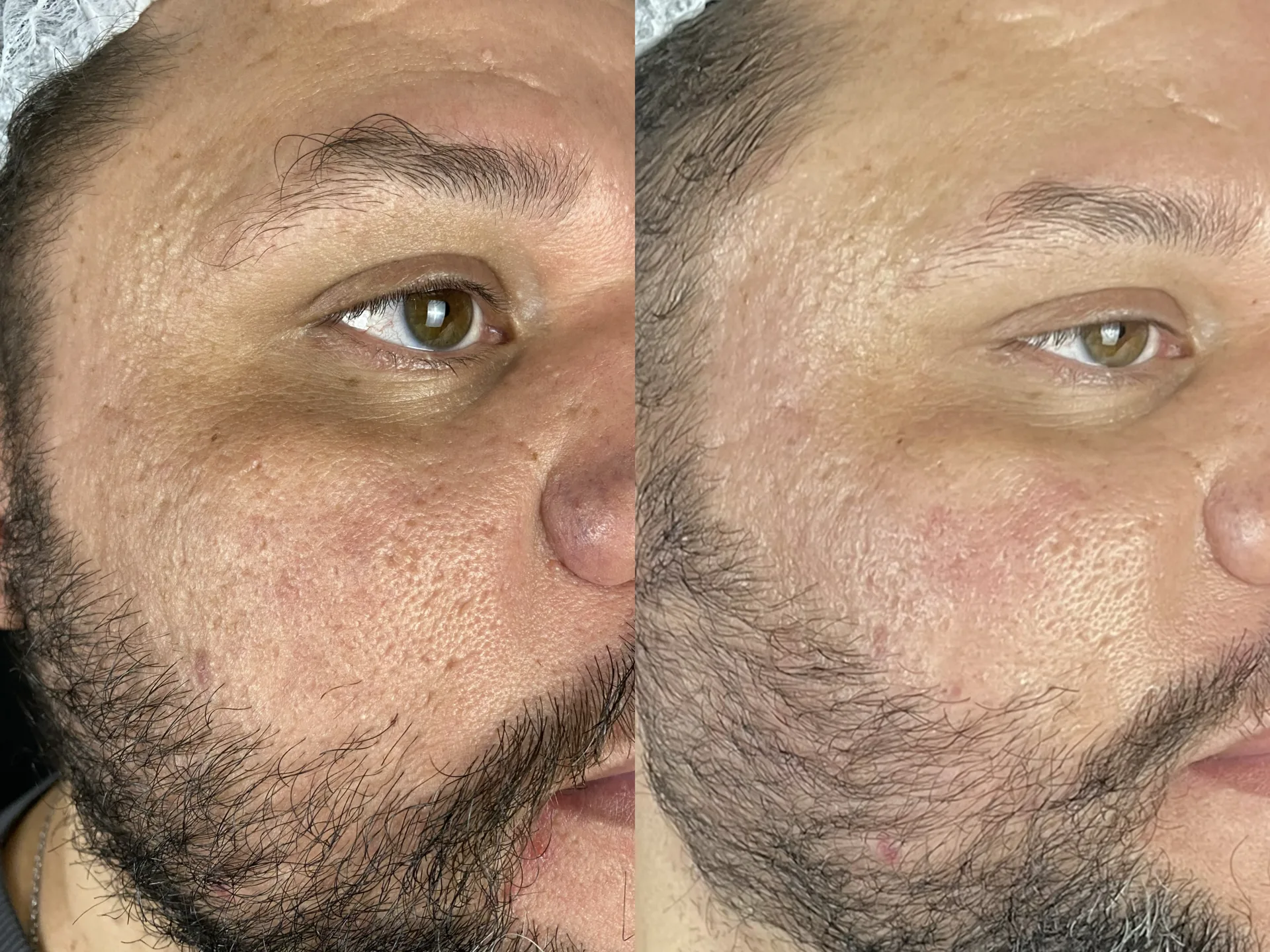 Cicatrizes de acne — resultado clínico 2