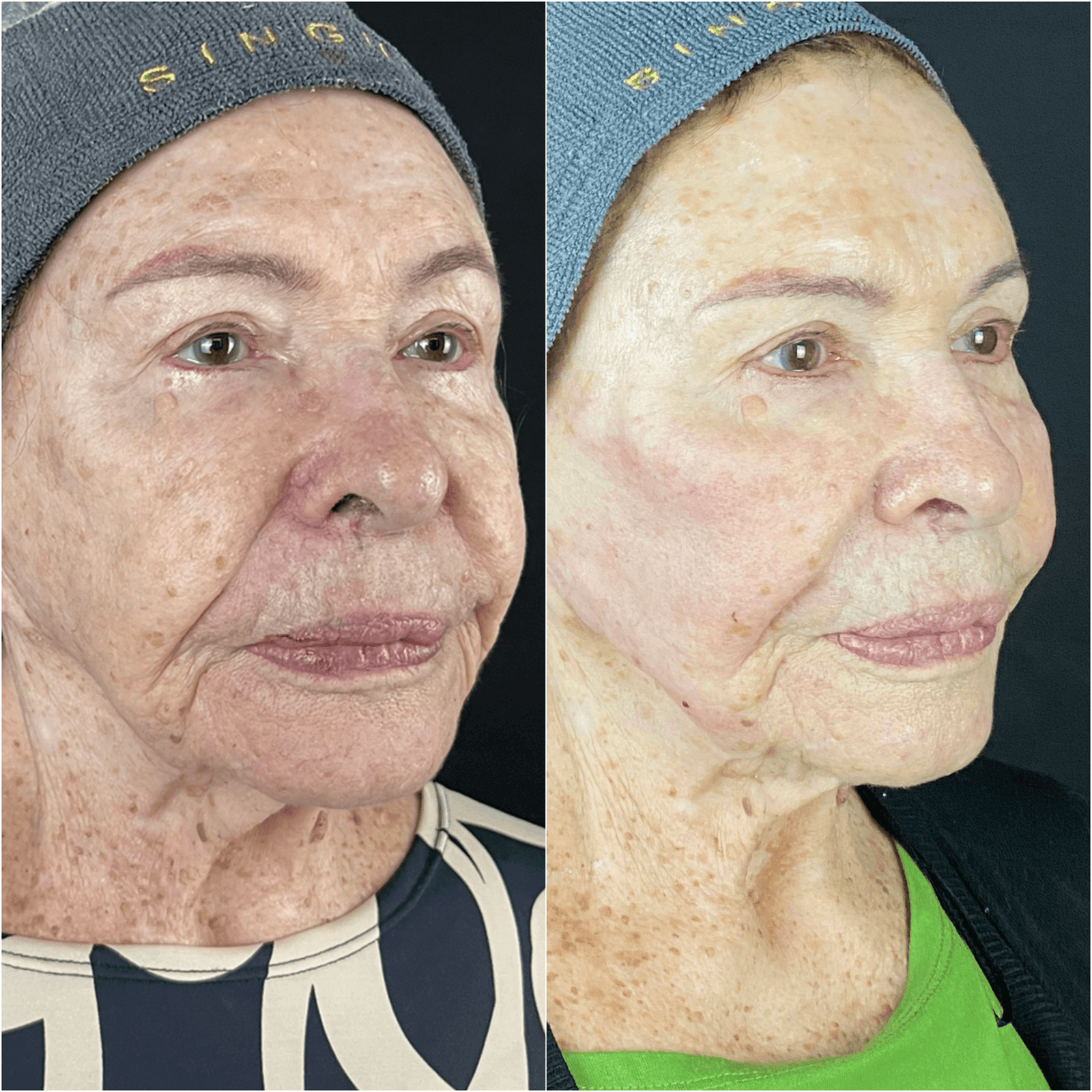 Derretimento facial — imagem clínica 1
