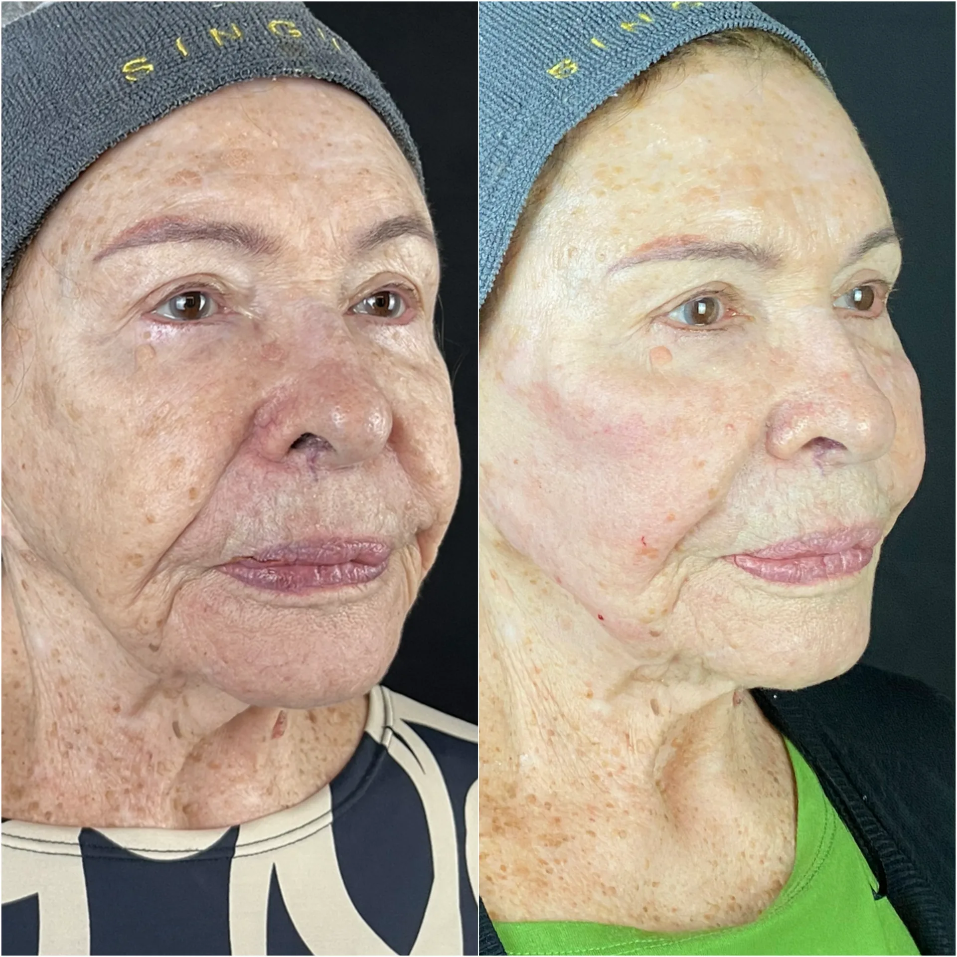 Derretimento facial — imagem clínica 1
