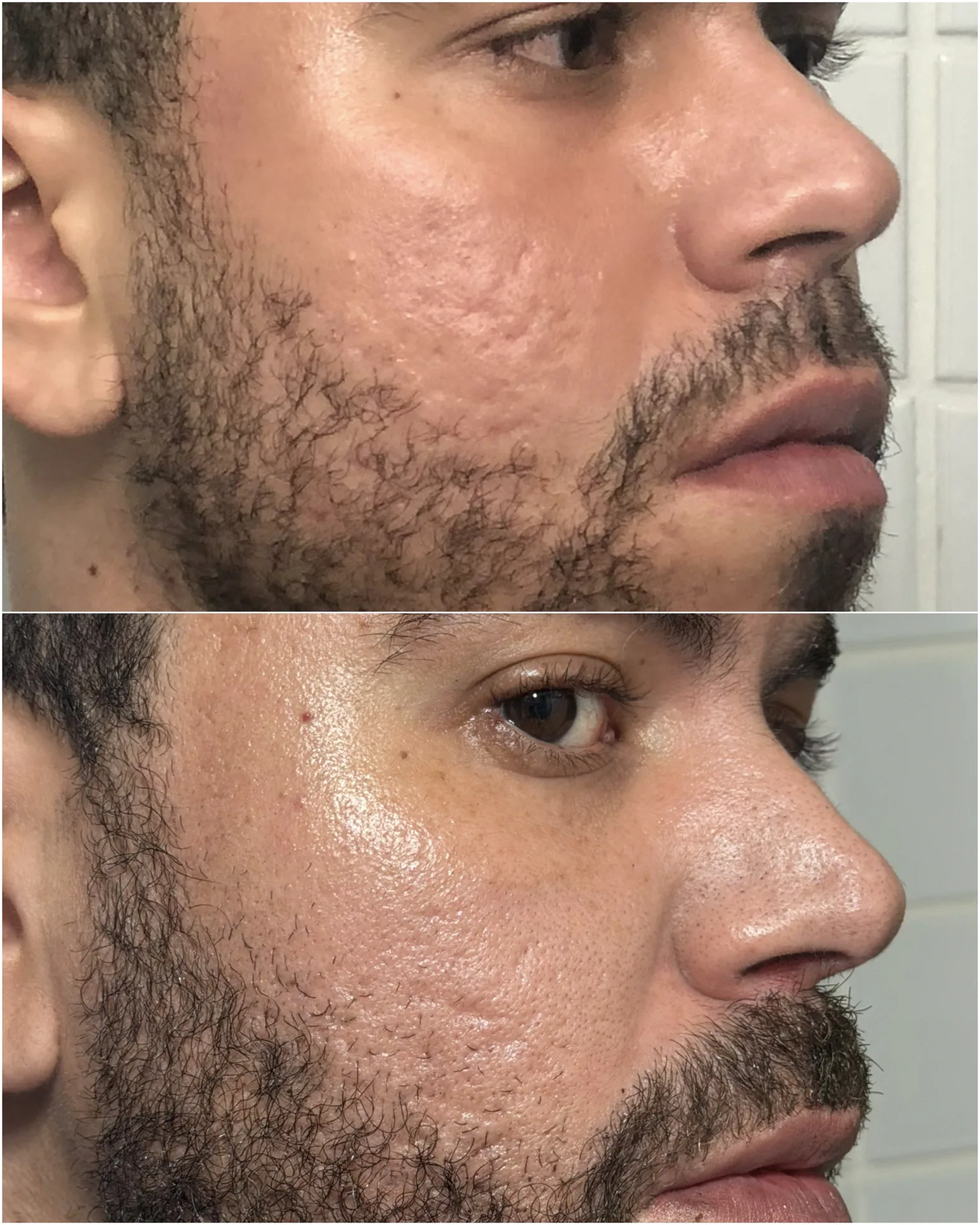 Cicatrizes de acne — resultado clínico 3