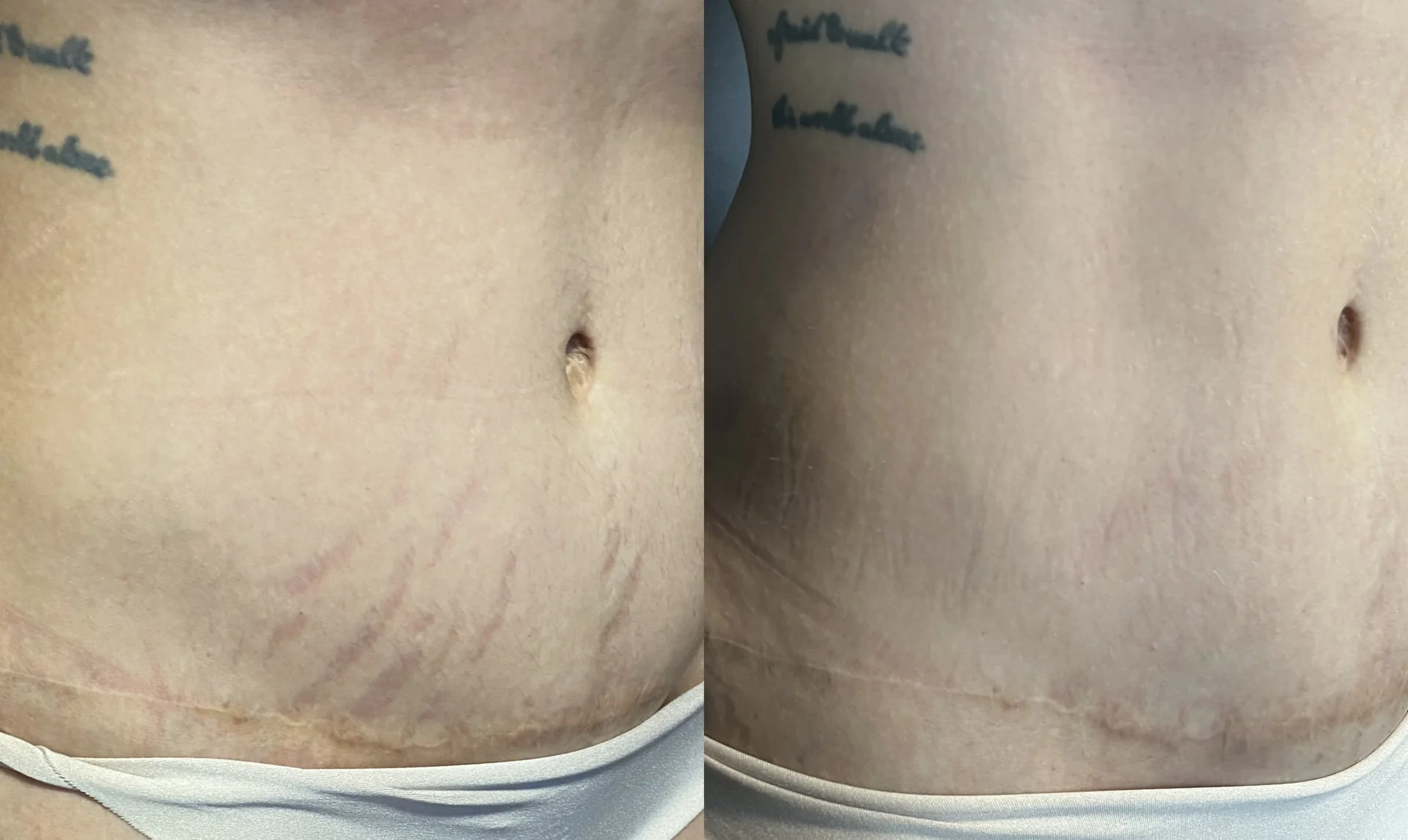 Resultado de tratamento de estrias e cicatriz abdominal